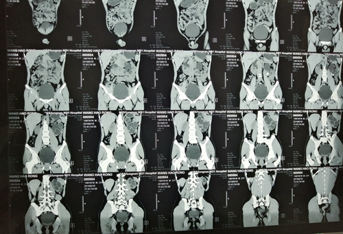 泌尿外科完成馬蹄腎合併腎結石患者經皮腎鏡碎石術