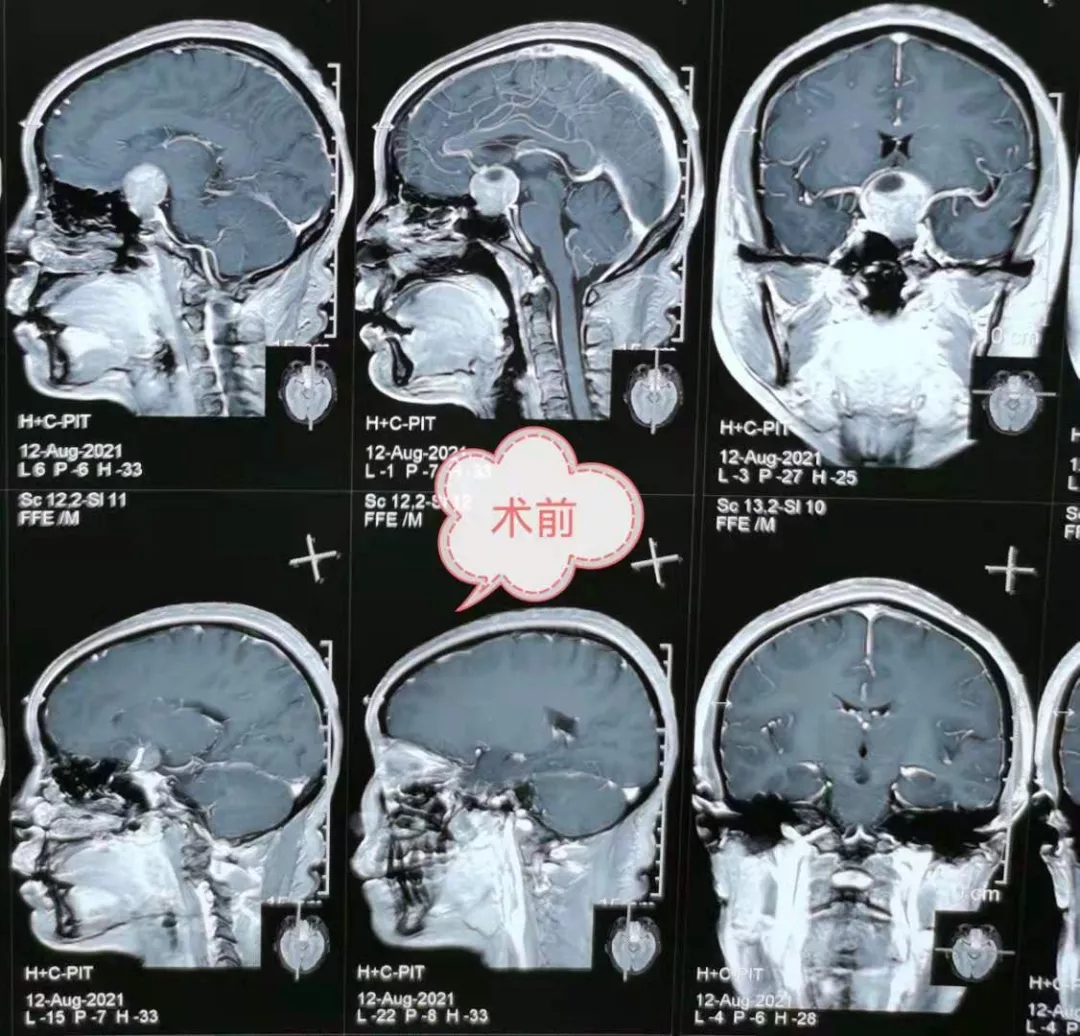 蝶窦 垂体瘤图片